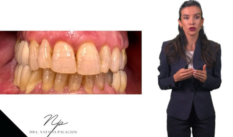 Avances en Odontología: El Rol del Ácido Hialurónico en Tratamientos Dentales
