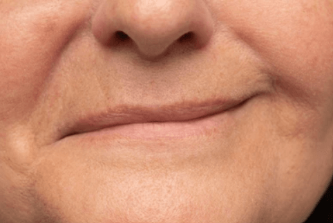 Equilibra tu Sonrisa: Asimetría de Labios con Ácido Hialurónico