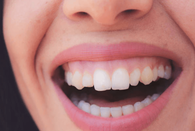 La Solución a la Sonrisa Gingival: Qué es y Cómo tratarla