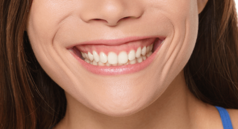 La Solución a la Sonrisa Gingival: Qué es y Cómo tratarla