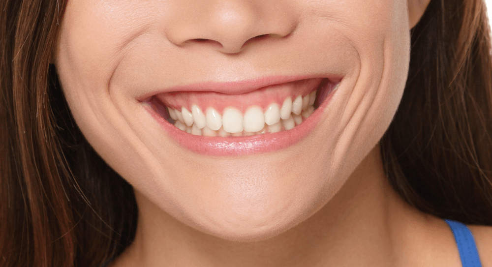 Sonrisa gingival: tratamiento con ácido hialurónico