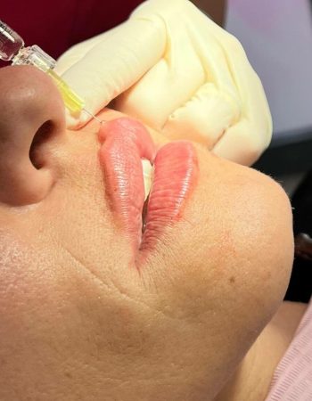 relleno de labios